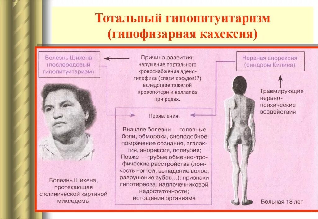 Болезнь Симмондса Шиена. Механизм развития гипофизарной кахексии. Гипоталамо-гипофизарная недостаточность симптомы. Болезнь Симмондса патанатомия.