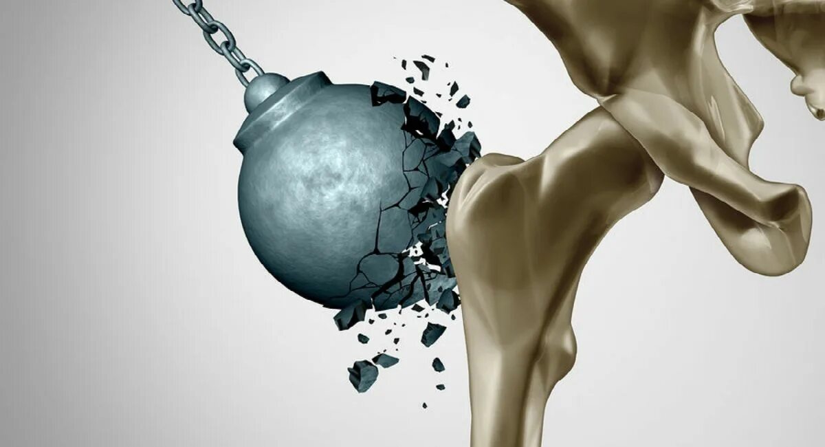 Нестабильность коленного сустава. Укрепление костей. Bone health. Крепкие кости. Укрепляются здоровье , кости и мышцы из-за спорта.