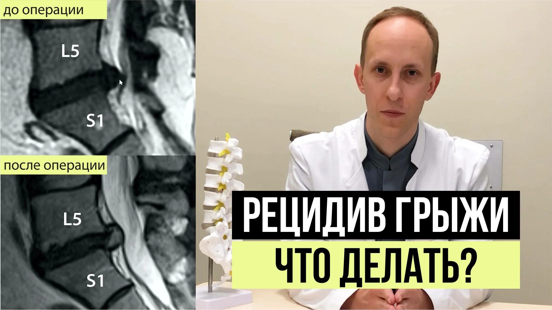 После грыжи сколько кг можно поднимать. Рецидив грыжи межпозвоночного диска. рецидивная и рецидивирующая грыжа.