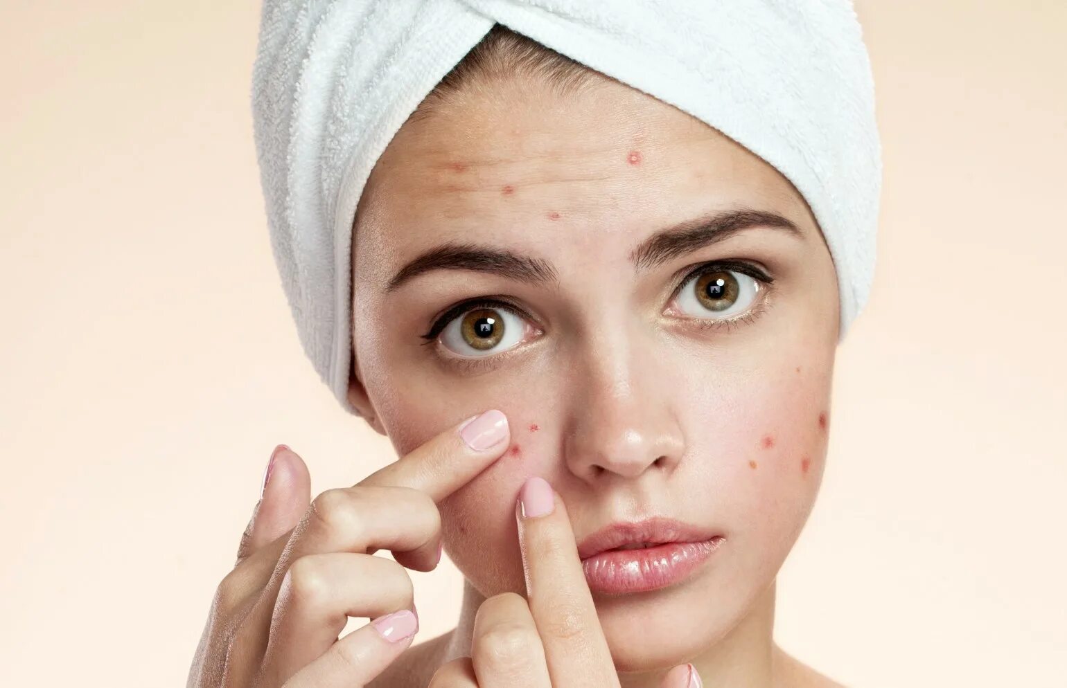 Acne pimple