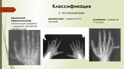 Аномалии в развитии кисти псевдоаутосомный