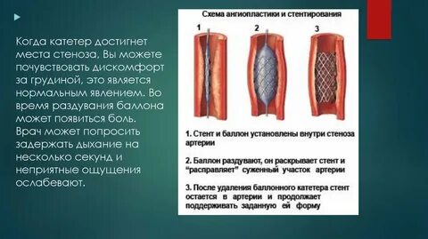 Нагрузка после стентирования