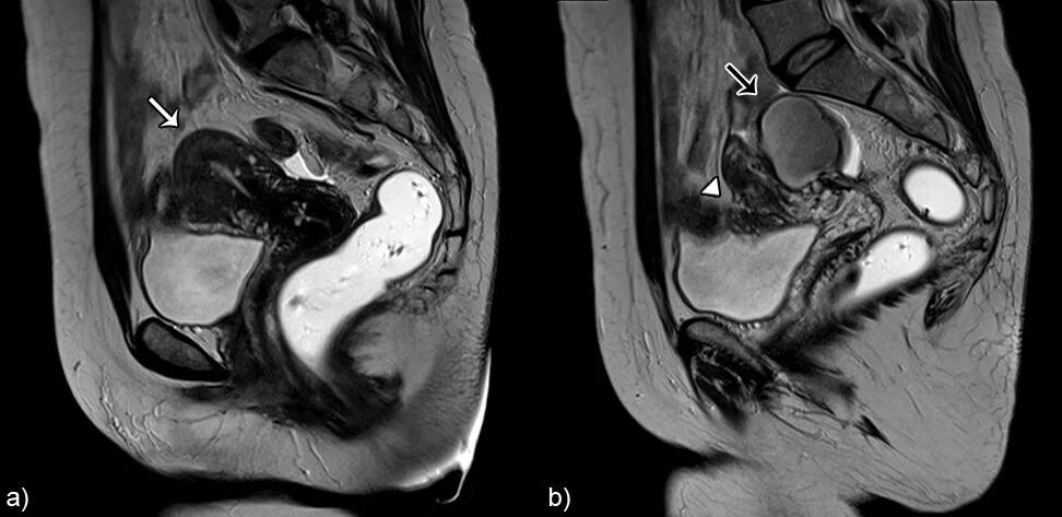 Ретроцервикальный эндометриоз. Эндометриома матки мрт. Мрт эндометрия