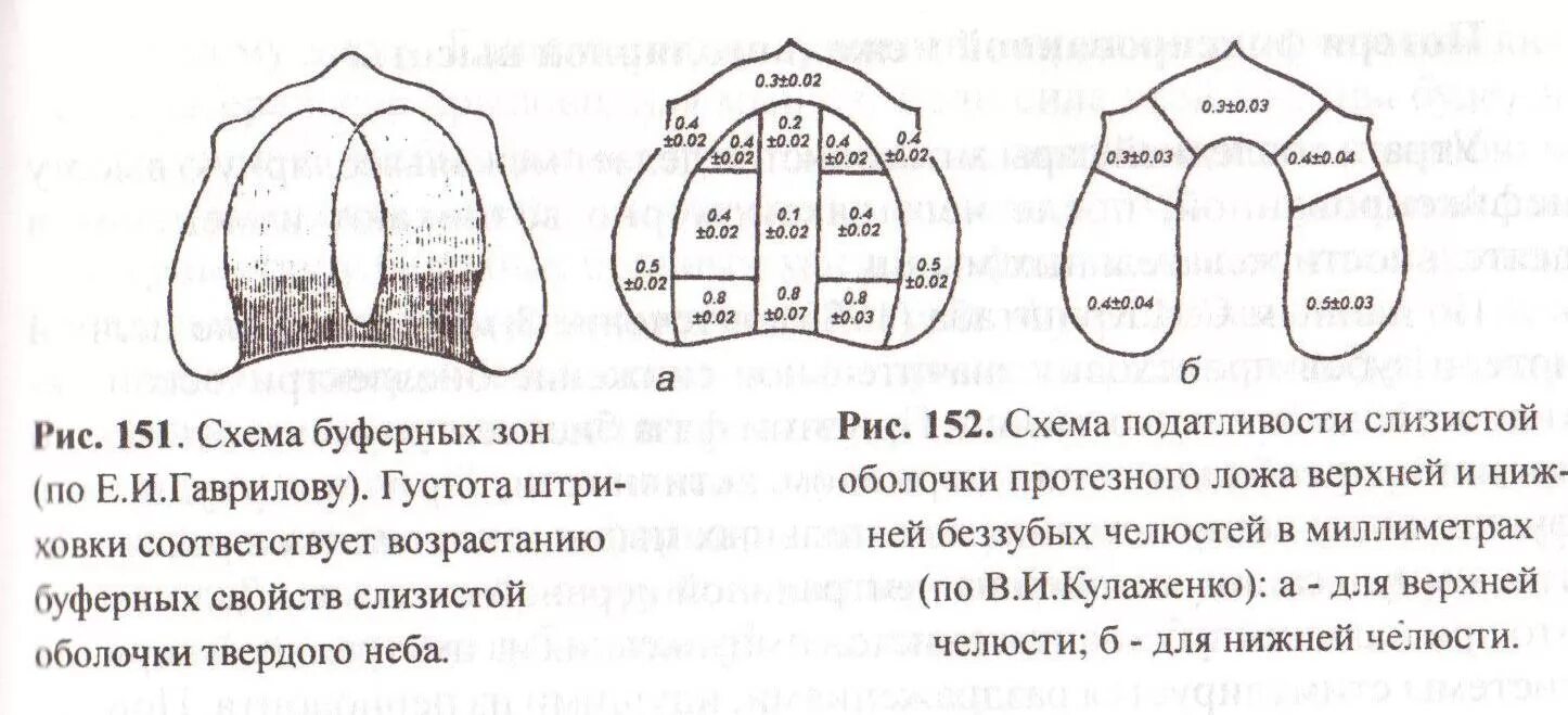 Зоны податливости слизистой. Зона податливости слизистой оболочки по Гаврилову. Буферные зоны слизистой оболочки по Гаврилову. Буферные зоны на верхней челюсти. Классификация слизистой оболочки по Люнду.