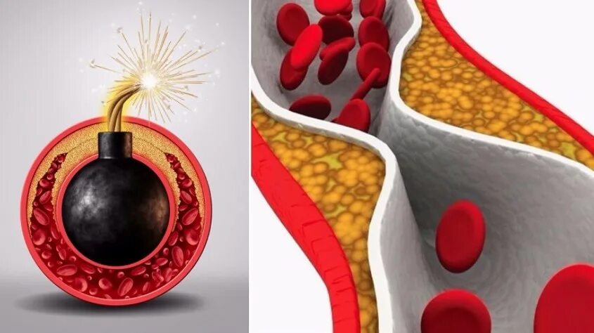 Чистый и холестериновый сосуд. Как очистить сосуды от холестериновых тромбов