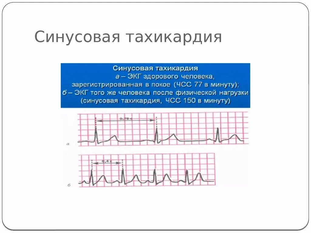 Учащенное сердцебиение при нагрузках. Синусовая тахикардия ЭКГ расшифровка. ЭКГ при синусовой тахикардии. ЭКГ критерии синусовой тахикардии. Кардиограмма при синусовой тахикардии.