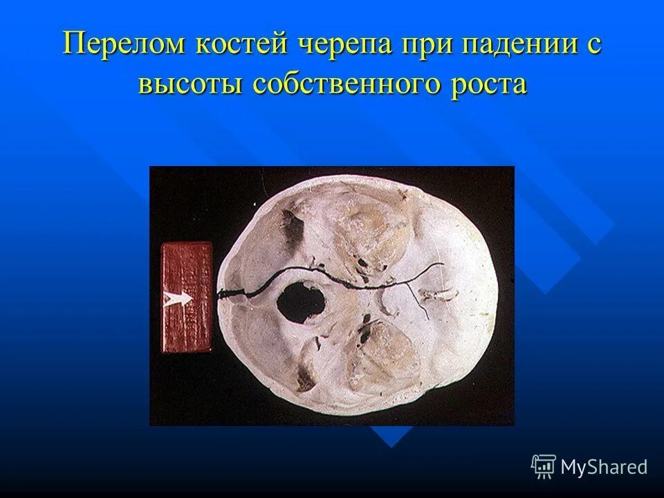 Череп разрыв. ЧМТ перелом свода черепа. ЗЧМТ перелом основания черепа. Открытая черепно-мозговая травма, перелом основания черепа. Перелом клиновидной кости черепа кт.