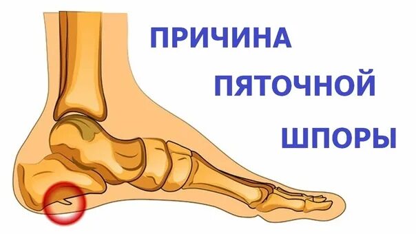 Синдром шпора пяточная. Пяточная шпора причины. пяточная шпора психосоматика. психосоматика шпоры пяточные. шпоры на пятках психосоматика.