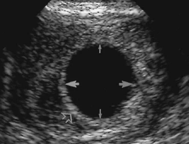 Анэмбриония – пустое плодное яйцо. Плодное яйцо 7 мм желточный мешок 6 мм. Анэмбриония – замершая беременность. 7 неделя не видно эмбриона
