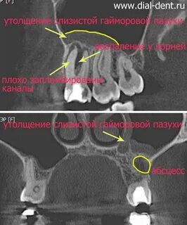 Киста правого верхней челюстной пазухи