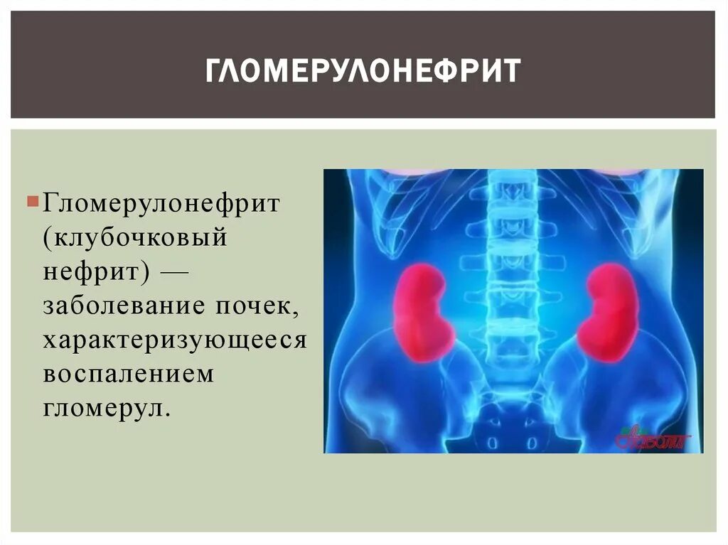 Заболевание почек гломерулонефрит. Нефрит заболевание почек. Нефрит воспаление почек. Гломерулонефрит клубочковый нефрит.