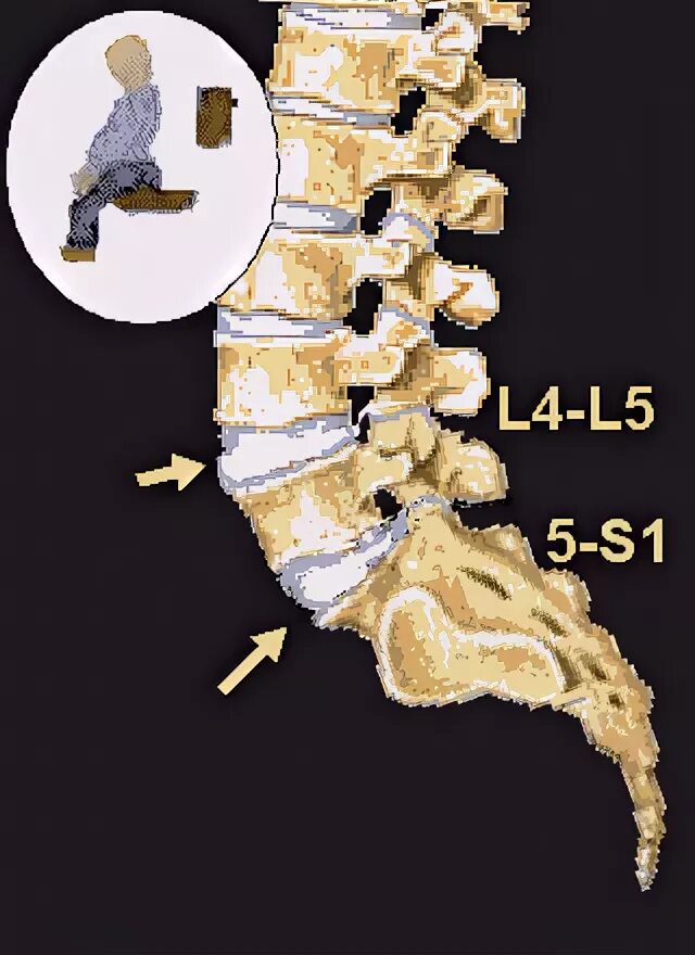 Позвоночник отдел l3 s1. Диск l1-l2 позвоночника. Позвонки l4 s1. Диски l2-l3 позвоночника. Диски позвонков l3-l4, l4-l5, l5-s1.