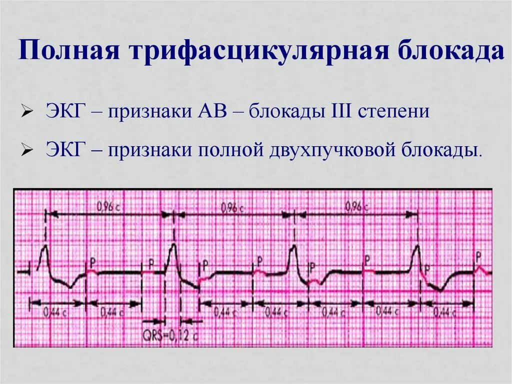 Атриовентрикулярная блокада признаки. Признаки av блокады 3 степени на ЭКГ. Узловая АВ блокада 1 степени на ЭКГ. Признаки АВ блокады 1 степени на ЭКГ. Нарушение проводимости атриовентрикулярная блокада 1 степени.