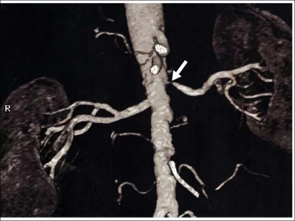 Стеноз почечной артерии кт. Кт ангиография почечных артерий. Стеноз почечной артерии ангиография. Тромбоз почечной артерии