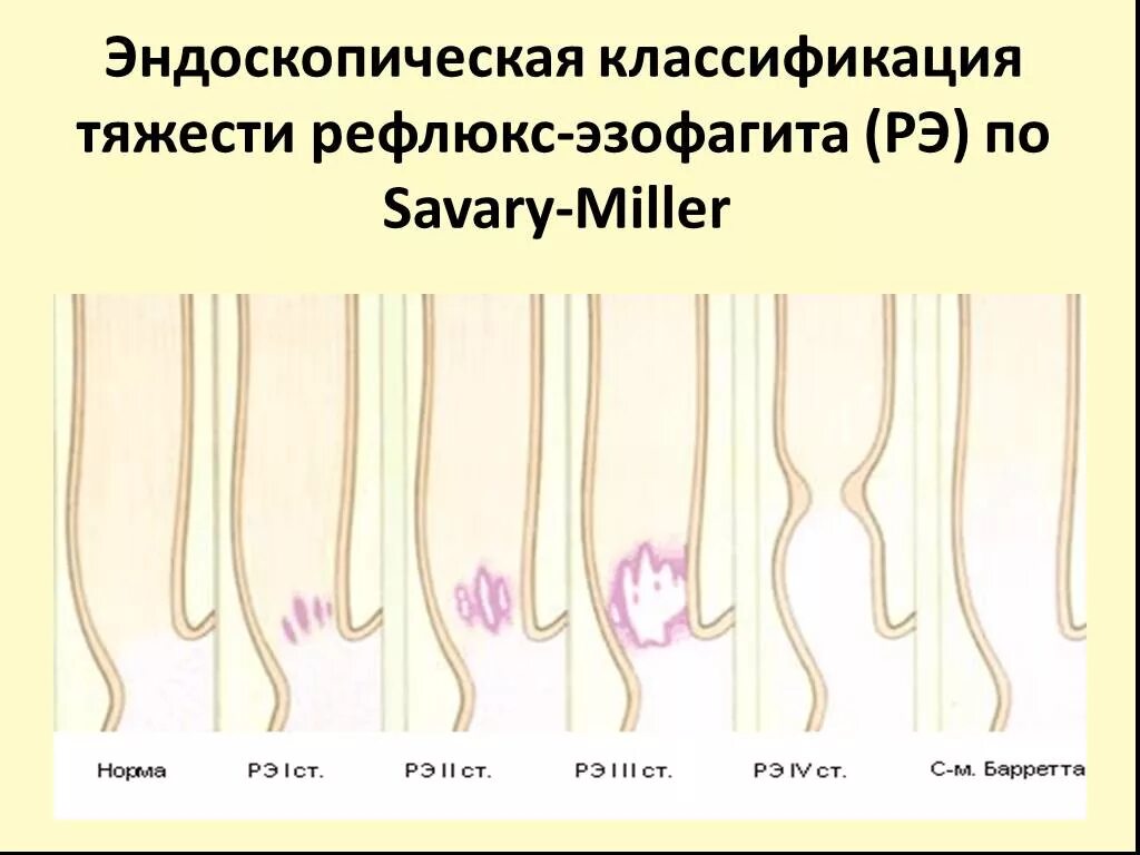 Рефлюкс эзофагит классификация. Рефлюкс эзофагит эндоскопическая классификация. Классификация Савари Миллера ГЭРБ. Классификация Savary-Miller рефлюкс-эзофагита. ГЭРБ классификация Savary-Miller.