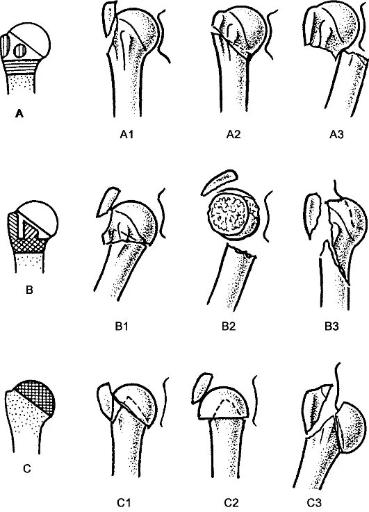 Классификация переломов верхнего сегмента плечевой кости. Классификация переломов проксимального отдела плечевой кости по АО. Классификация переломов верхнего сегмента плечевой кости рис. Перелом проксимального отдела плечевой кости.