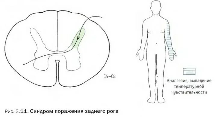 Поражение передних рогов. Синдром поражения передних Рогов спинного мозга. Симптомы поражения задних Рогов спинного мозга. Синдром поражения заднего рога спинного мозга. Синдром поражения задних Корешков спинного мозга.