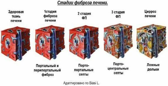 Фиброз печени 4 степени сколько. Фиброз печени 2-3 степени. первая стадия фиброза печени.