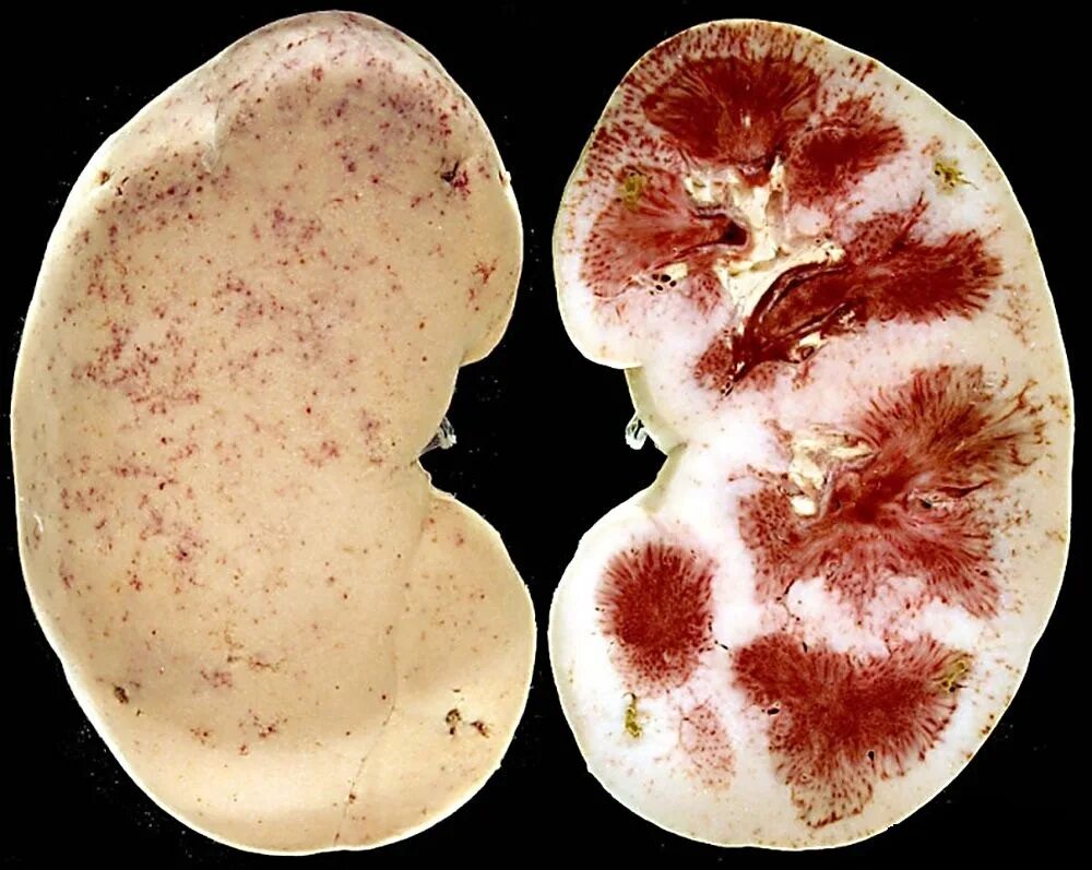 Острый нефрит пиелонефрит. Хронический нефрит макропрепарат. Пиелонефрит почек макропрепарат. Острый гломерулонефрит патанатомия.