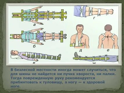 Прибинтовать конечность к туловищу