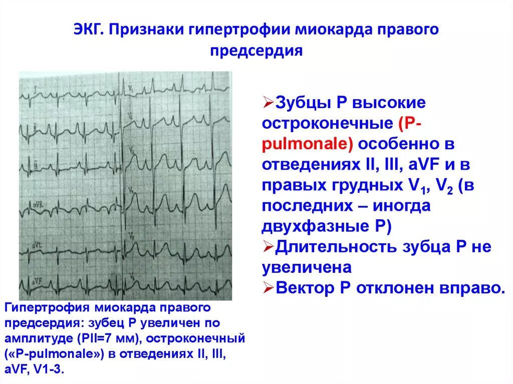 Признаки гипертрофии предсердий на ЭКГ. ЭКГ высокий зубец r в v1-v2. Гипертрофия левого желудочка на ЭКГ. Гипертрофия предсердий и желудочков на ЭКГ. Гипертрофия левого предсердия левого желудочка