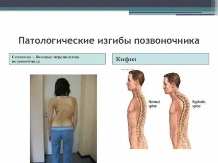 Деформации позвоночного столба