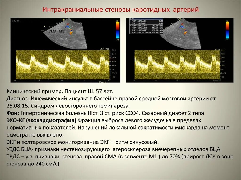 Нестенозирующий атеросклероз бца что это. Нестенозирующий атеросклероз артерий. Нестенозирующий атеросклероз внечерепных отделов бца что это. Стенозирующий атеросклероз брахиоцефальных артерий симптомы. Признаки нестенозирующего атеросклероза.