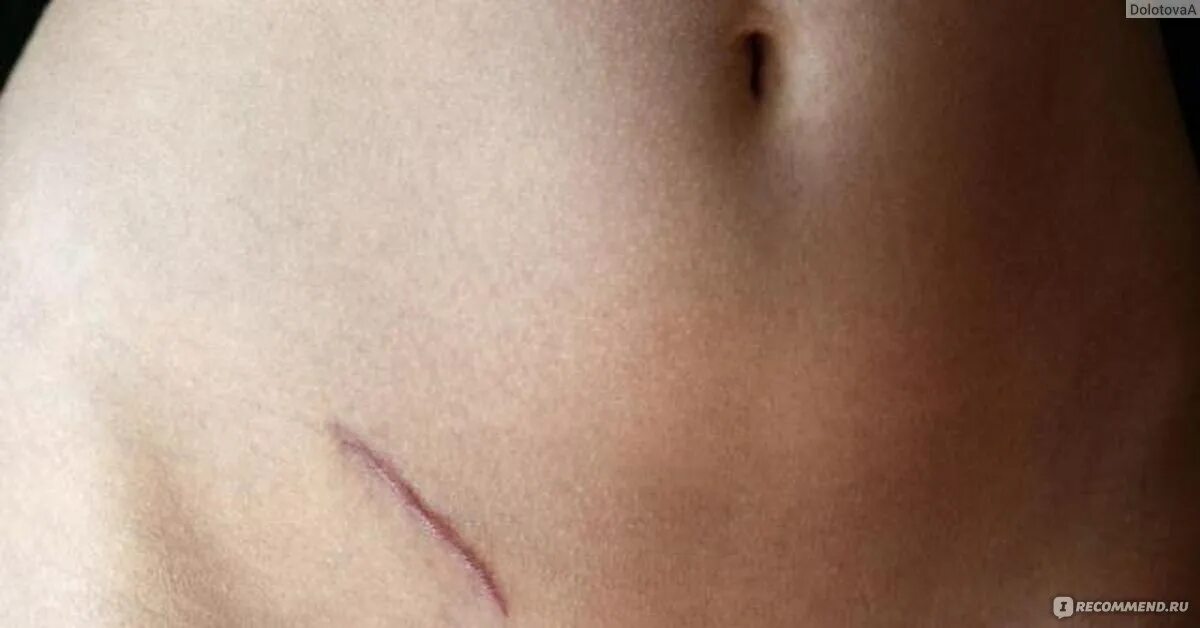 Tattoo on a scar, scar and burn mark - All about tattoo