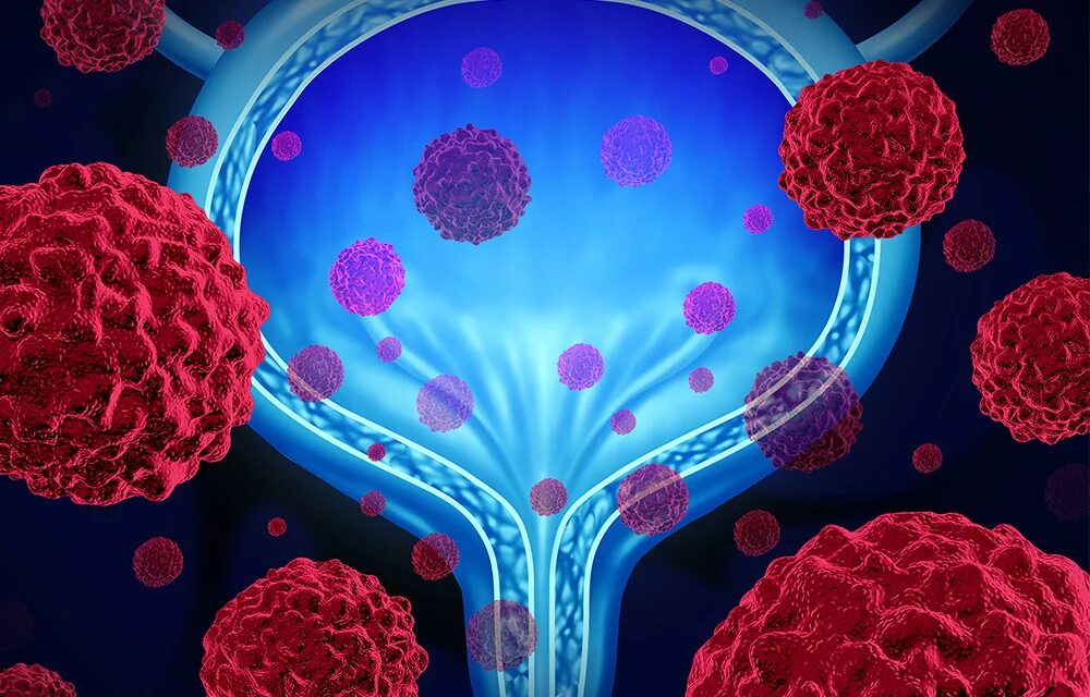 Иммунотерапия мочевого пузыря. Таргетная иммунотерапия. Онкология мочевого пузыря. Опухоль мочевого пузыря клиника.