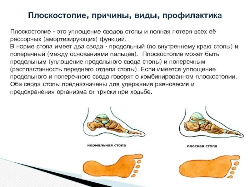 Плоскостопие может быть предотвращено. Продольный свод стопы уплощен. плоскостопие стопа сбоку. этиология плоскостопия.