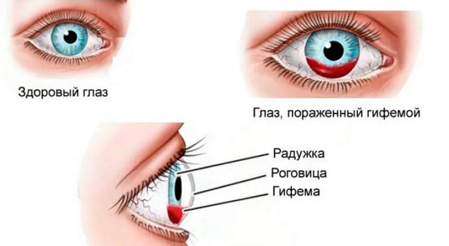 Контузия глазного яблока. Кровоизлияние в глаз гифема.