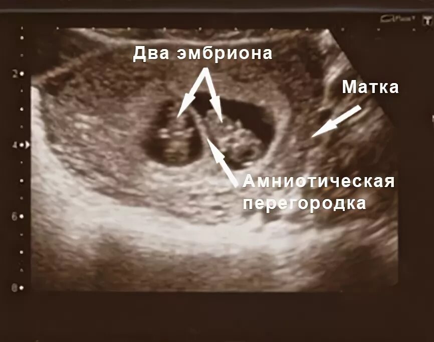 УЗИ 8 недель беременности Близнецы. УЗИ двойни на 8 неделе беременности фото. УЗИ при беременности двойни 8 недель. УЗИ 8 недель беременности двойня. Двойня 8 недель