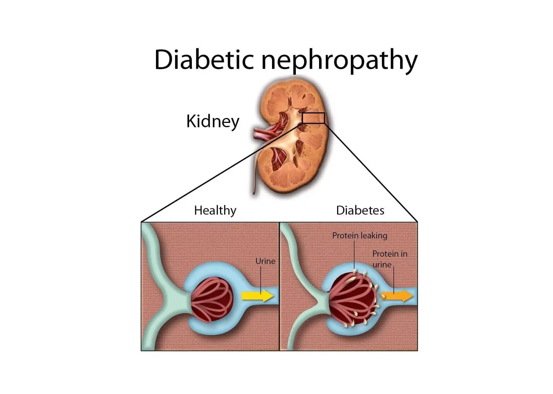 Почему в почках белок. Нефропатия сахарный диабет. Осложнения сахарного диабета - нефропатия. Диабетическая нефропатия схемы. Диабетическая нефропатия почка.