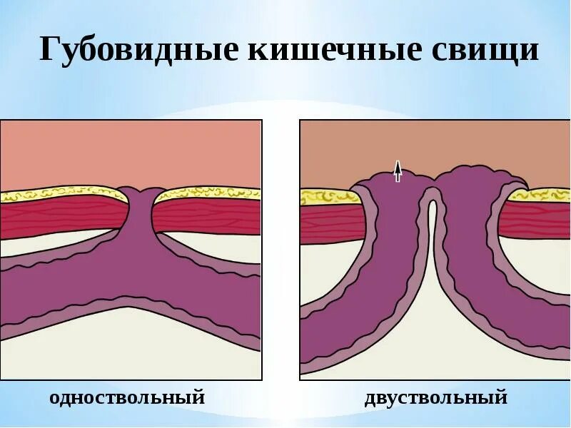 Кишечный свищ. Трубчатый кишечный свищ. губовидный кишечный свищ. губовидные и трубчатые свищи. полный и неполный кишечный свищ.