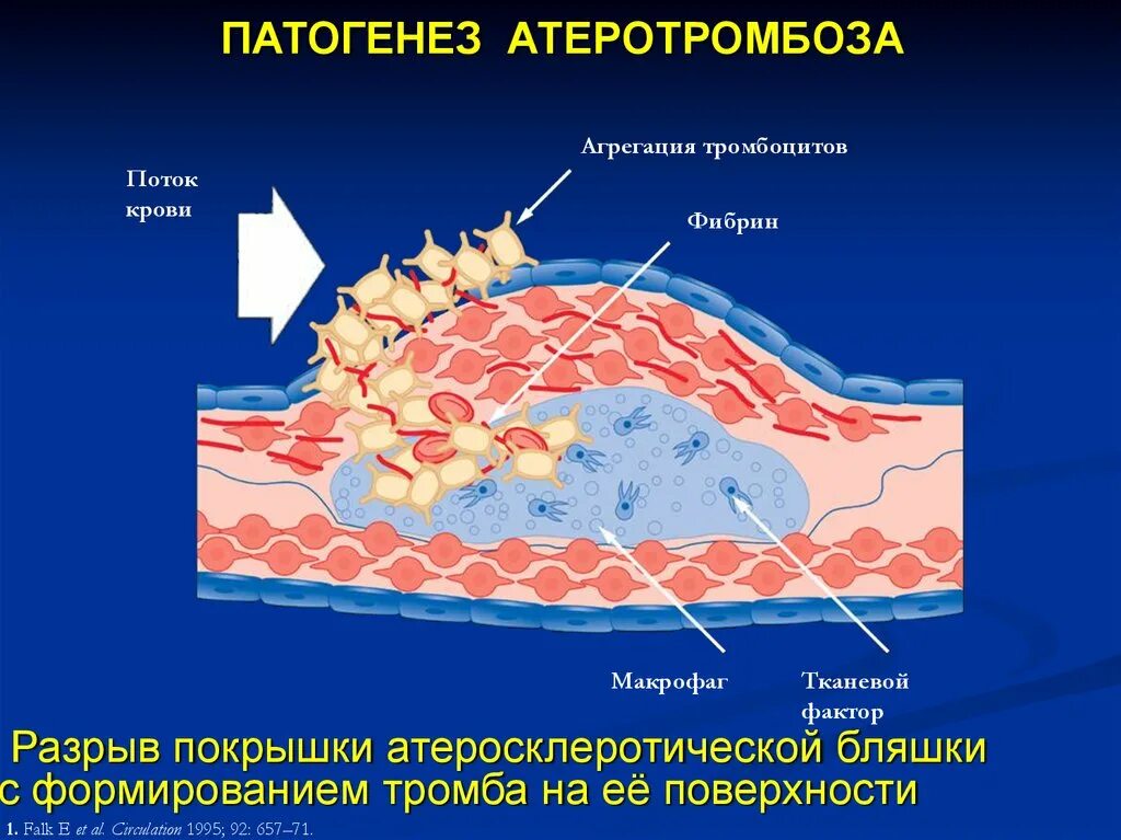 Разрыв атеросклеротической бляшки патогенез. Разрыв капсулы атеросклеротической бляшки. Образование атеросклеротической бляшки патогенез.