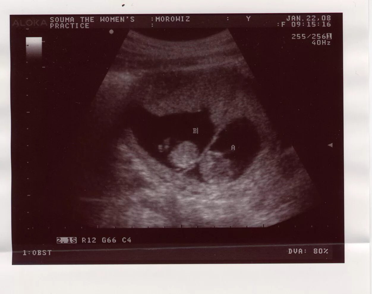 УЗИ 12 недель беременности двойня. Монохориальная моноамниотическая двойня УЗИ 7 недель. Монохориальная двойня УЗИ 7 недель. УЗИ 7 недель беременности двойня. Двойня 7 недель