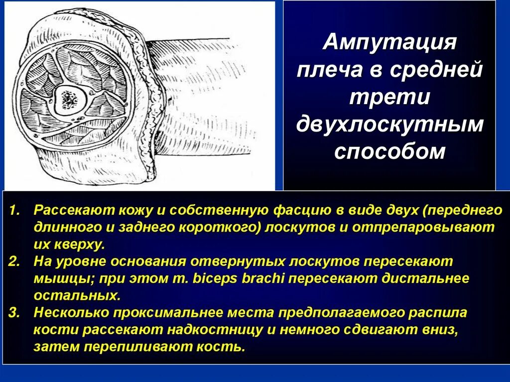 Сосуды при ампутации. Ампутация плеча в средней трети. Ампутация на уровне верхней трети плеча. Ампутация предплечья в средней трети двухлоскутным способом. Ампутация плеча в средней трети круговым способом.