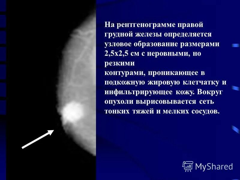 доброкачественное образование в молочной железе. узловое образование молочной железы что это такое. узловая фиброзно-кистозная мастопатия. образование молочной железы. доброкачественные новообразования мол железы.