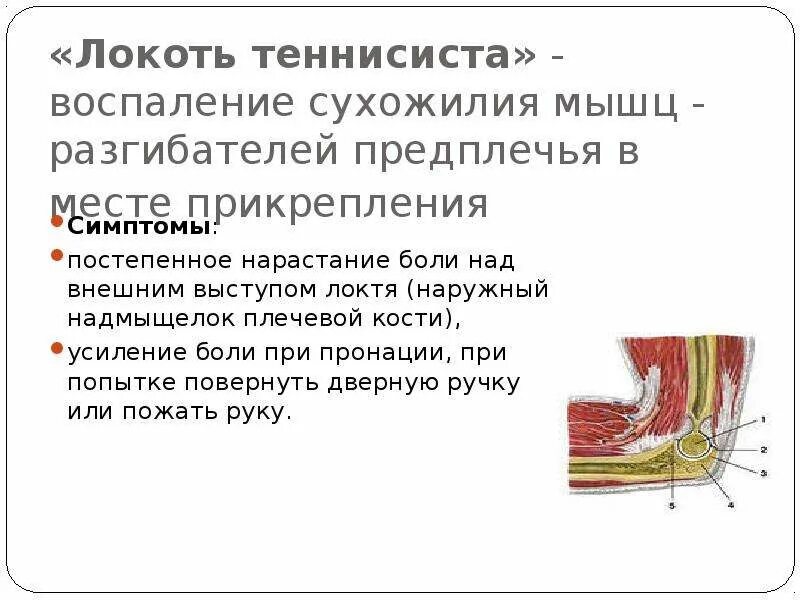 Как называется болезнь локтя. Теннисная болезнь локтя. болезнь теннисиста в локтевом суставе. синдром теннисиста в локтевом суставе.