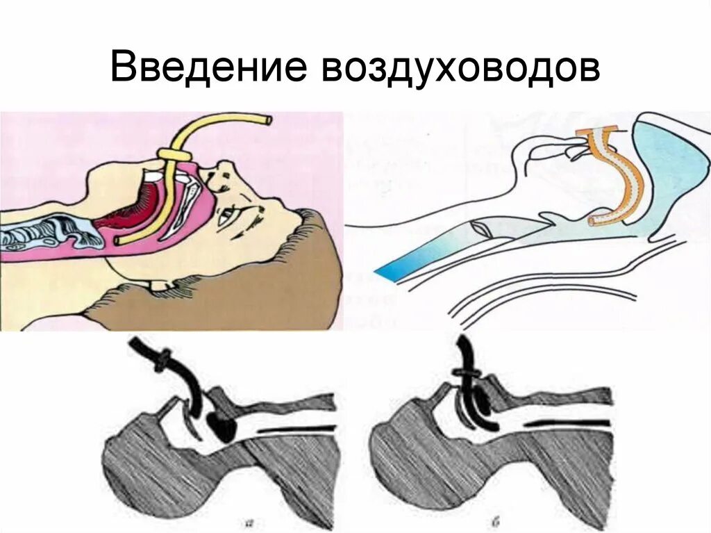 Вводи плавнее. Воздуховод Гведела алгоритм. Введение s образной трубки воздуховода. Введение орофарингеального воздуховода. Введение оротрахеального воздуховода алгоритм.
