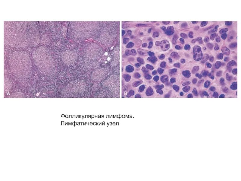 Диффузная лимфома гистология. Крупноклеточная лимфома гистология. Неходжкинская лимфома гистология. Анапластическая крупноклеточная лимфома гистология. Реактивная гиперплазия лимфоузла