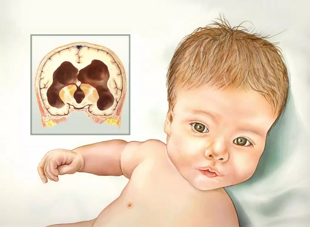 Поражение мозга у новорожденных. Гидроцефалия головного мозга у ребенка. Внутренняя гидроцефалия головного мозга у грудничка. Гидроцефалия головного мозга синдромы у ребенка. Гидроцефалия врождённая у плода.