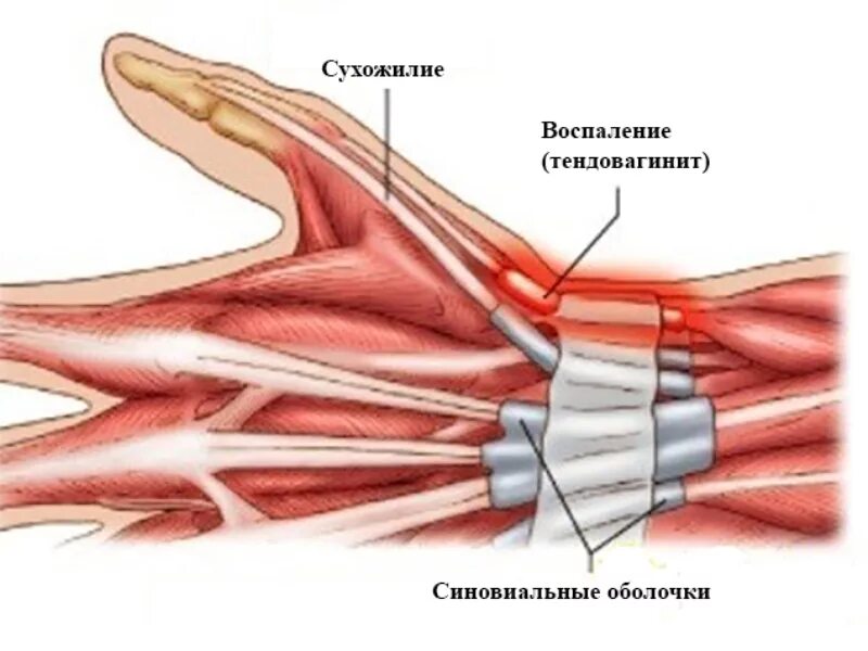 Воспаление сухожилия на руке