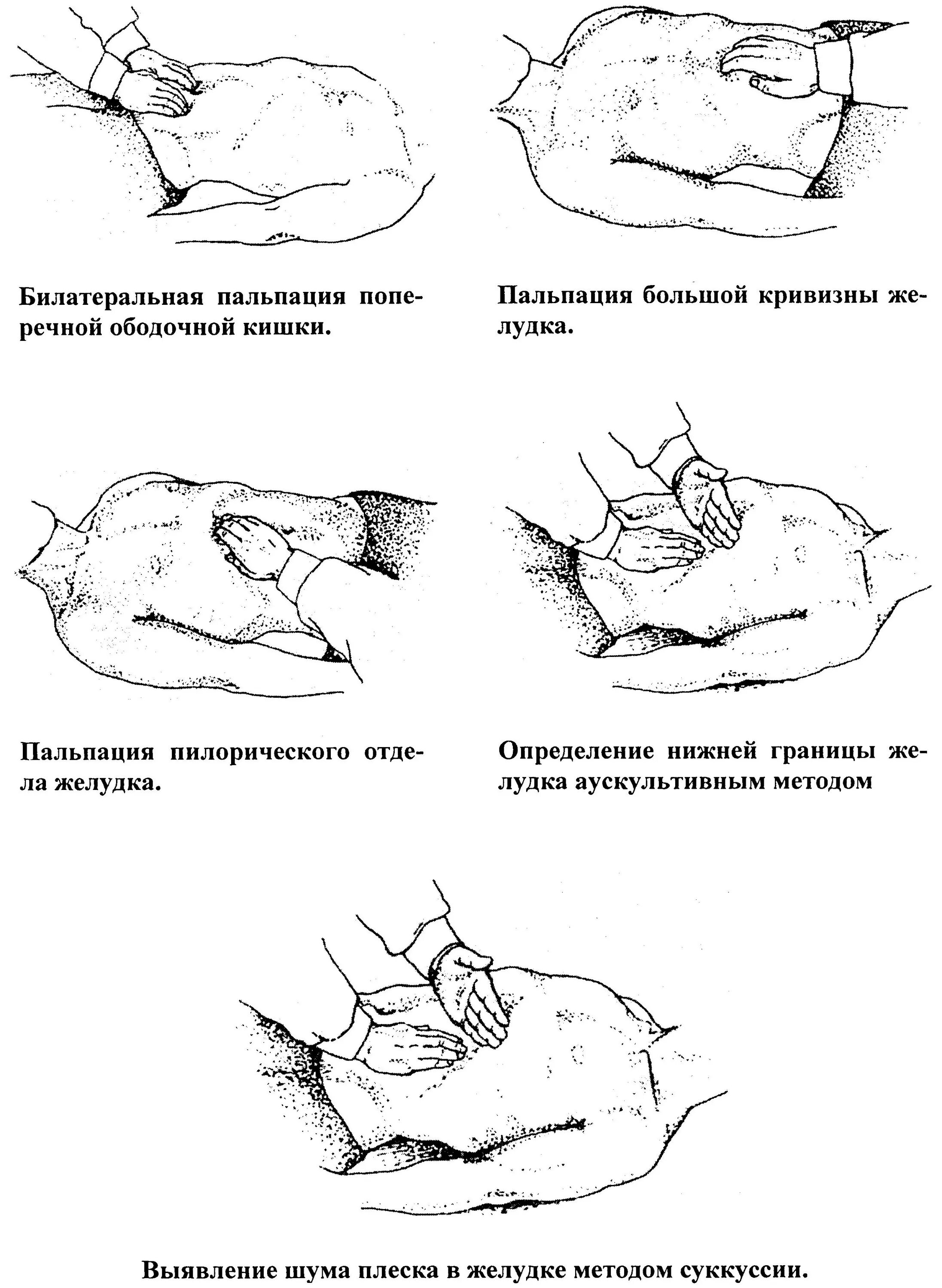 Пальпация живота. Пальпация пилорического отдела желудка. Схема поверхностной пальпации живота. Пальпация ЖКТ пропедевтика схема. Пальпация большой кривизны желудка.