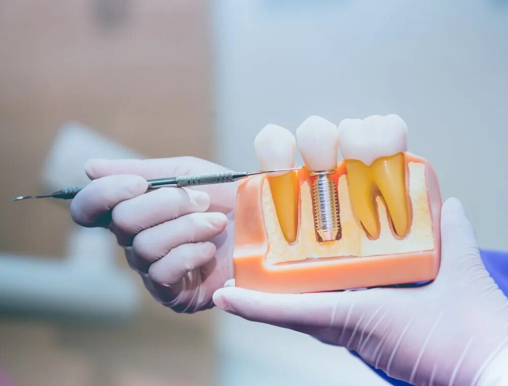 Три стоматолога. Подготовка к имплантации. Подготовка к имплантации зубов. Подготовка к имплантации зуба. Протетика стоматология.