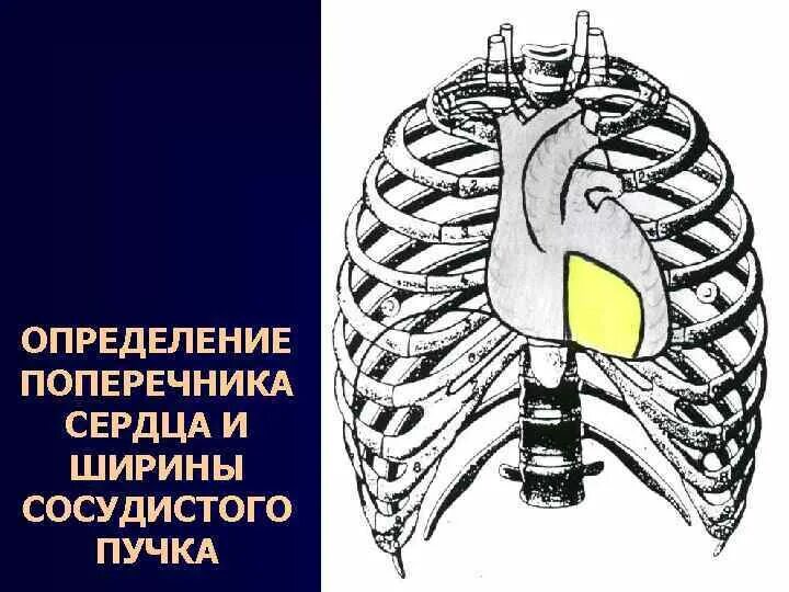 Поперечник сердца. Расширение поперечника сердца. Увеличение поперечника сердца. Определение поперечника сердца. Длинник и поперечник