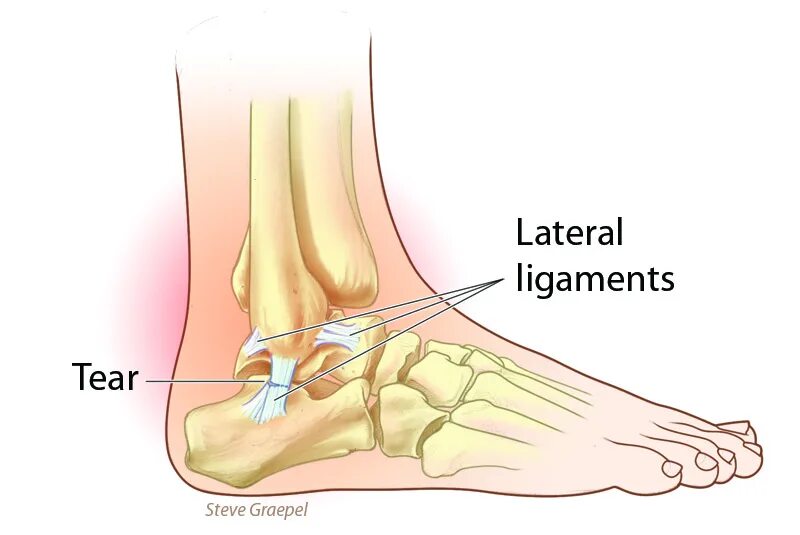 Латеральный разрыв. Растяжение связок голеностопного сустава. Разрыв связок голеностопного сустава. Надрыв связок голеностопного сустава. Разрыв связок голеностопного сустава и стопы.