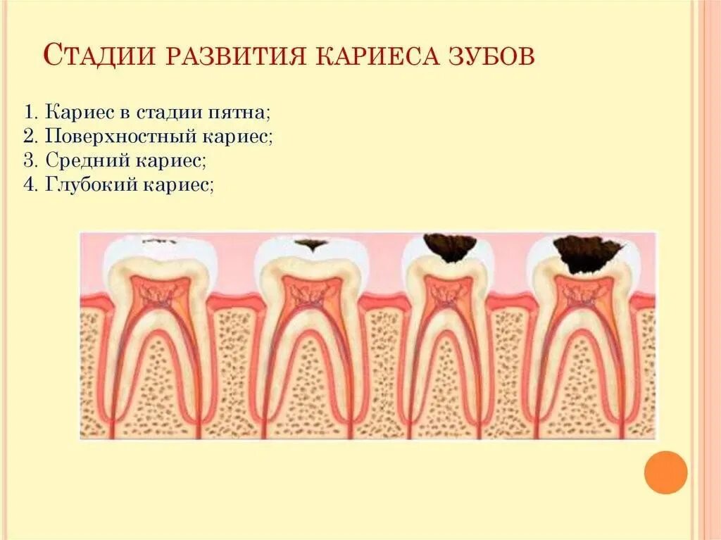 Кариас. Кариас. Кариес дентина глубокий. Кариас. Кариес дентина и средний кариес.