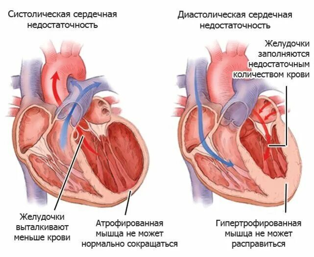 Дисфункции желудочков сердца. Систолическая недостаточность левого желудочка. Систолическая и диастолическая сердечная недостаточность. Диастолическая форма сердечной недостаточности патогенез. Хроническая сердечная недостаточность патогенез диастолической.
