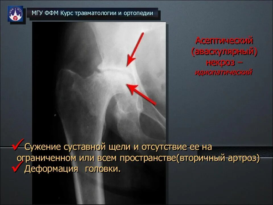 Асептический некроз бедренных костей. Асептический некроз коленного сустава рентген. Асептический некроз коленного кости. Асептический некроз медиального мыщелка. Асептический некроз без операции